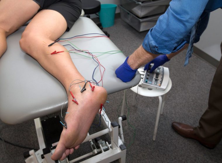 Dry-Needle-Therapy1