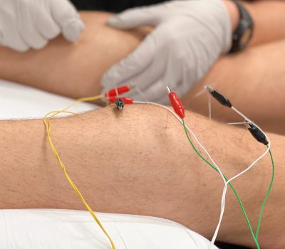 Dry-Needle-Therapy2