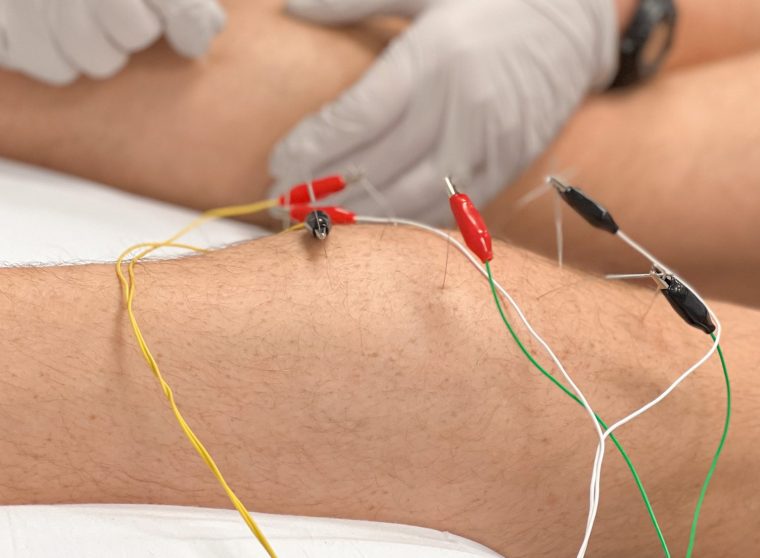 Dry-Needle-Therapy2