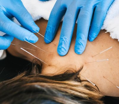 Dry-Needle-Therapy3