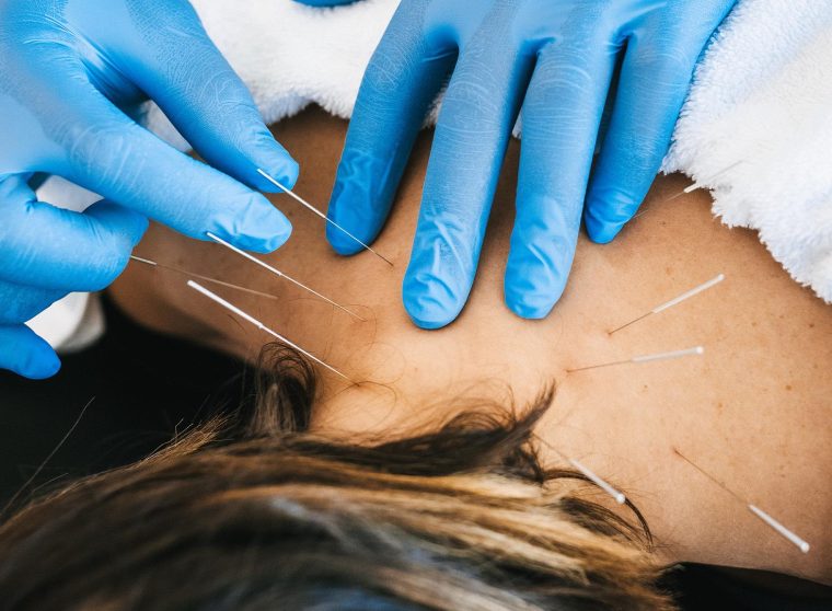 Dry-Needle-Therapy3