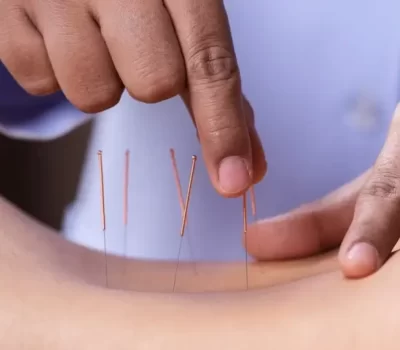 Dry Needling3
