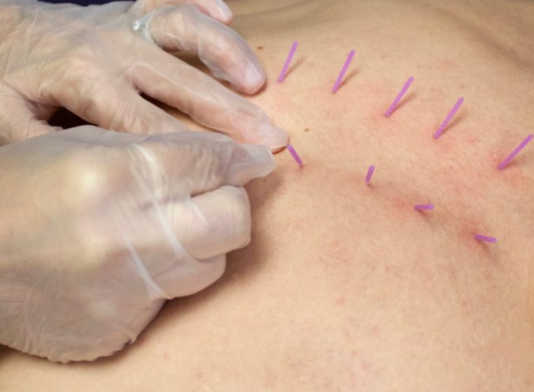 Dry Needling2