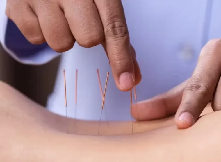 Dry Needling3